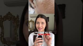 How to get rid of acne scars? || Dr. Jushya Bhatia Sarin ||