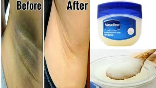 How to Get rid Of Dark Underarms in 3 Minutes ( instant result ) using Vaseline 100% Effective