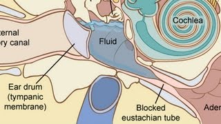 How to Treat Fluid in the Ear | Ear Problems
