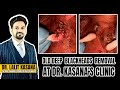 OLD DEEP BLACKHEADS REMOVAL AT DR.KASANA'S CLINIC
