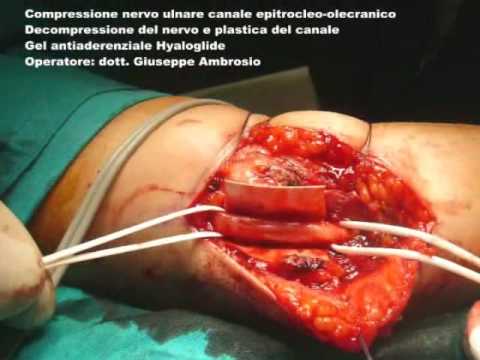 Destra dellanca coxartrosi congiunta di grado 3 N, D ° Ð »Ð ° нÑ, Ð ° л ÐμÑ ‡ ÐμниÐμ ÑÐμи Ñ DN † DD ° л ÑŒÐ½Ñ <й Ñ Ð ° йÑ,