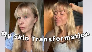 My Skincare Transformation - How I Transformed My Hormonal Acne in Under 6 Months