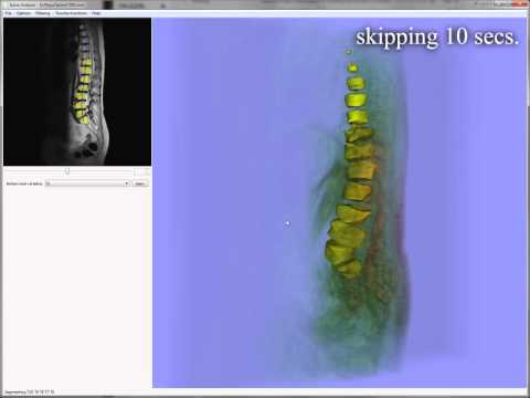 Robust Detection and Segmentation for Diagnosis of Vertebral Diseases using Routine MR Images