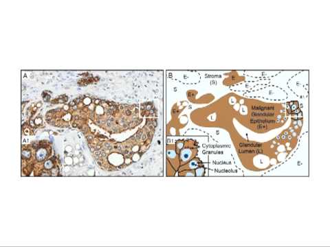 XMRV, a New Human Retrovirus? (Lecture 25)
