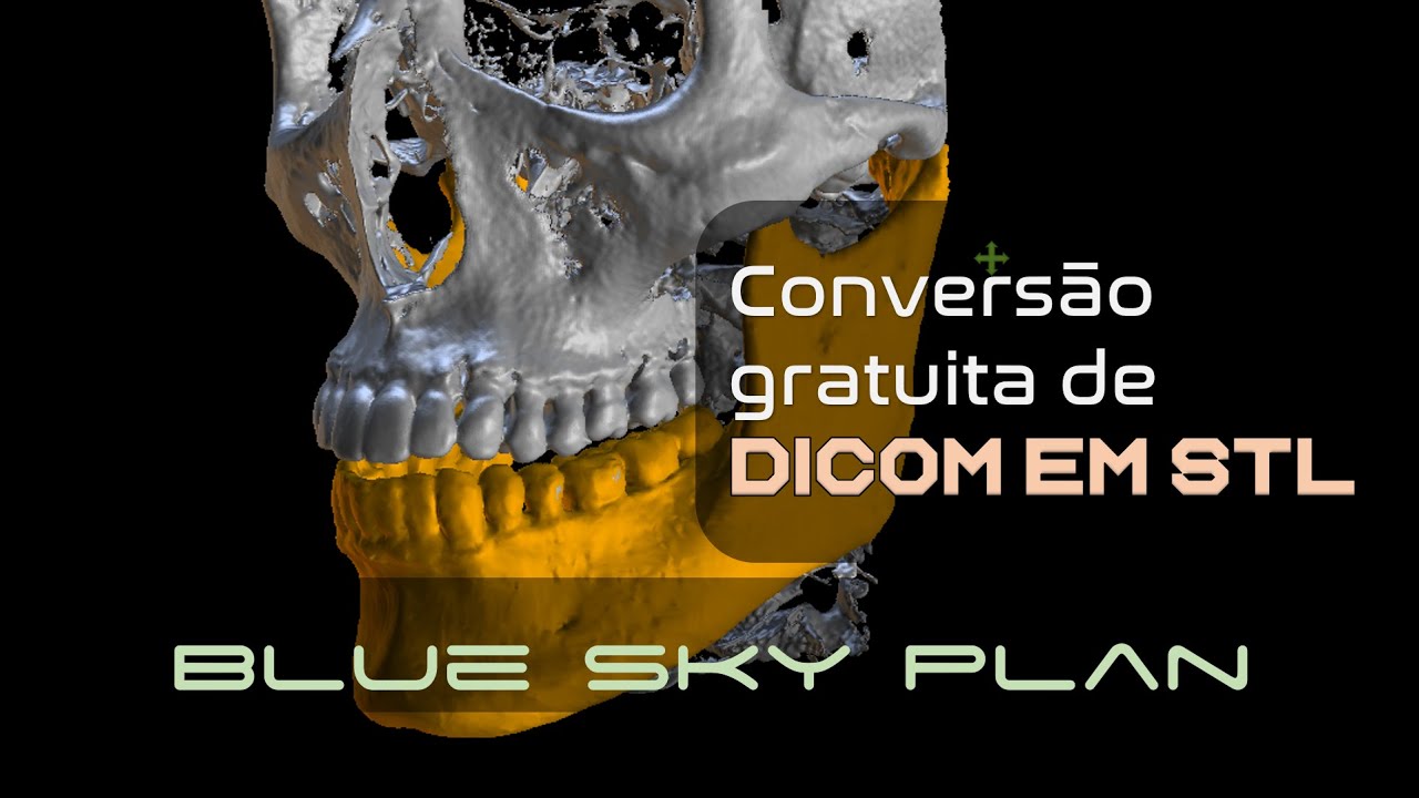 Conversão Rápida e Gratuita de DICOM em STL pelo Blue Sky Plan