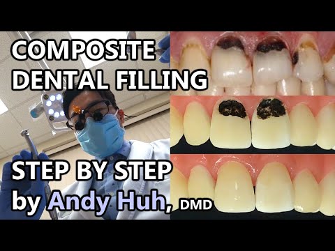 Composite Dental Filling Procedure Steps, Tooth-colored, White  레진 충치 치료 Andy Huh @ Evergreen Dental