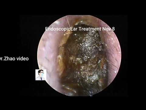 Ear Wax Removal