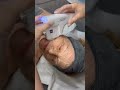 Radio Frequency And HiFu Combination Treatment Clinicbe Rf Hifu Clinicbe Skin Antiaging