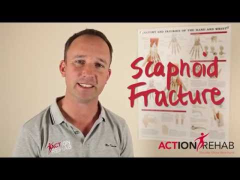 Scaphoid Fracture Treatment