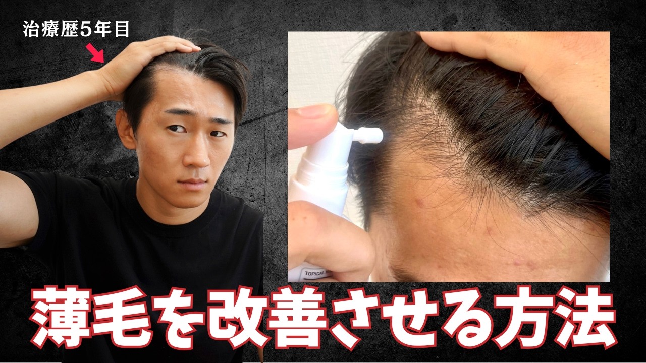 【永久保存版🔰】薄毛を本気で改善させる方法とは？【治療歴5年】