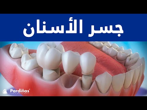 18/05/2023 12:00:00 ص
جسر الأسنان © ,,, https://www.youtube.com/embed/3w1o0kHRoHI
