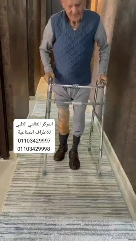 فيديو: تجربة عميل مع تركيب طرف صناعي في المركز