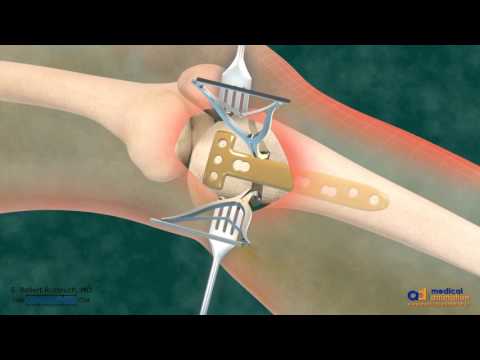Image - High Tibial Osteotomy (HTO) for Bowleg Correction Surgical Animation