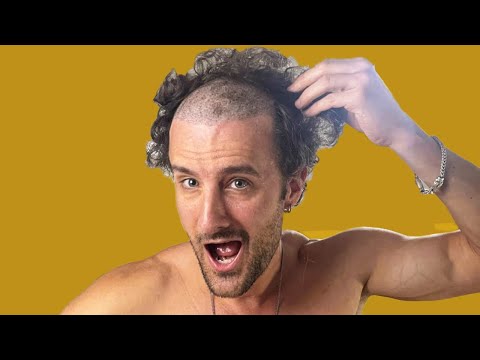 Shaving My Head 1yr Post-Hair Transplant 😮