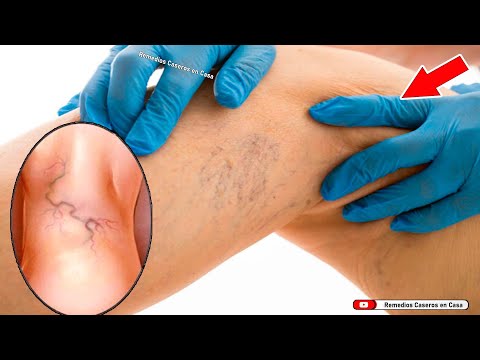 APLICÁNDOLE ESTO A LAS VARICES  ELLA ELIMINO TENÍA PIES CON MUCHAS VENAS VARICOSAS