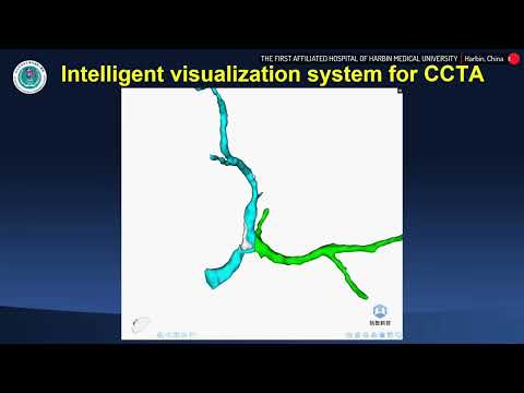 IVUS-Guided PCI Of LM Bifurcation