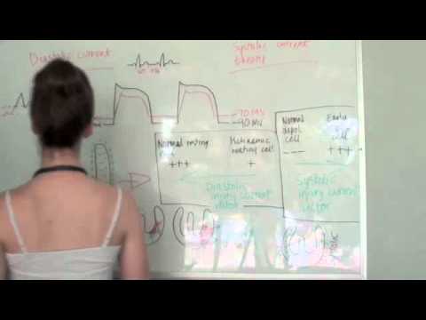 ST Segment Elevation/Depression - Why Does It Happen?