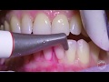 How teeth should be cleaned at the Dentist / Hygienist