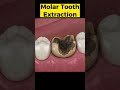Tooth Extraction 3D Animation Toothextraction Toothdecay