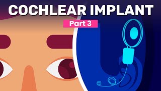 Cochlear Implant Surgery