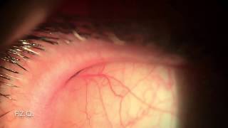 Extracción de un trozo de lentilla del fórnix superior.