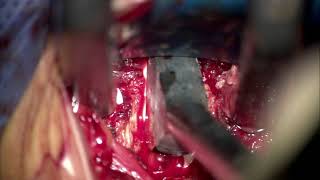 DISCECTOMIA CERVICAL C4 C5, C5 C6