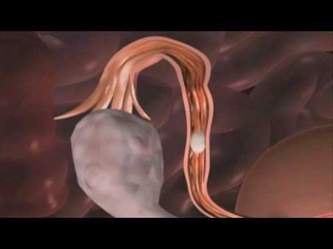 MALADIE INFLAMMATOIRE PELVIENNE OU MIP