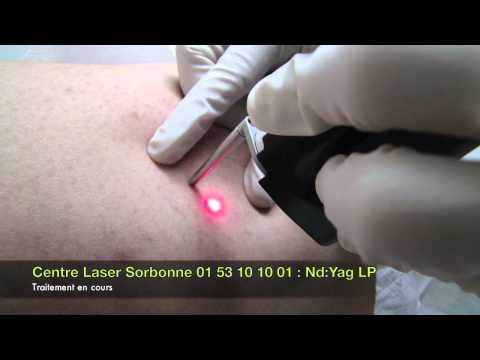 Varice traitement laser
