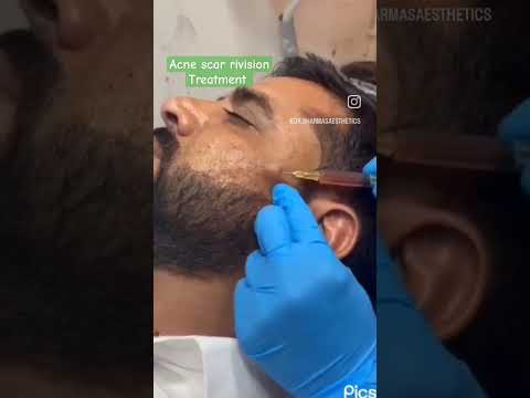 Acne scar Treatment.
