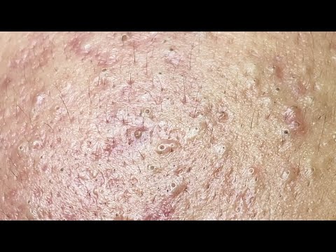 Satisfying ASMR Blackhead Removal: Relaxation and Clear Skin