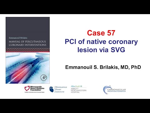 Case 57: PCI Manual - Native coronary PCI via SVG