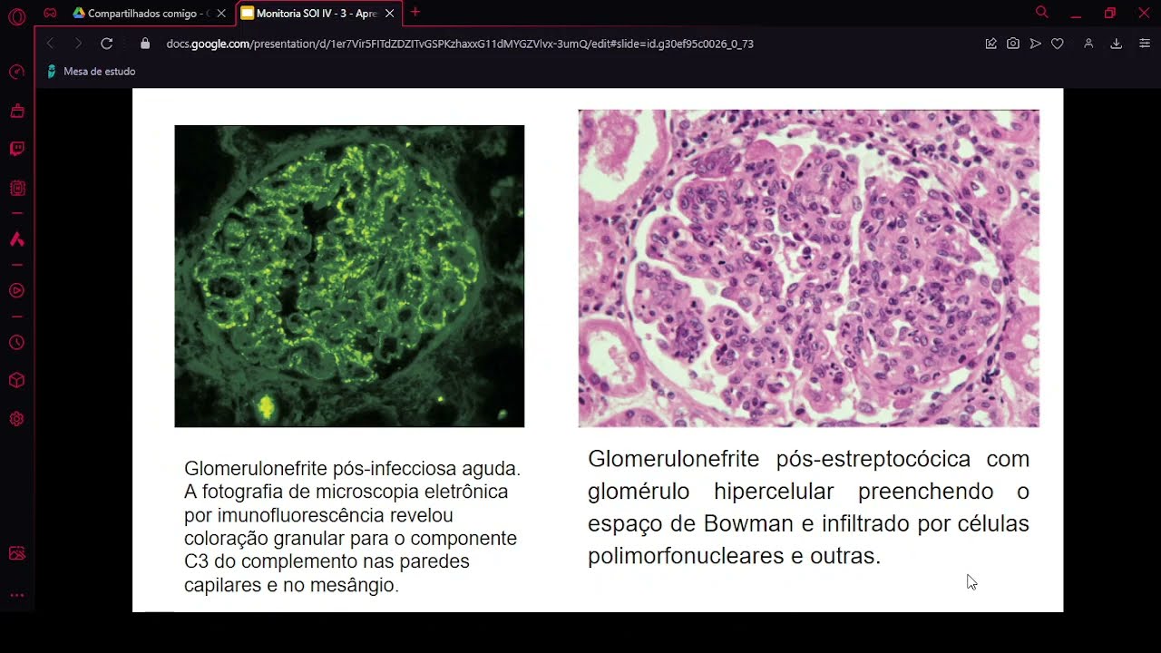 Distúrbios da função glomerular: introdução à síndrome nefrítica e nefrótica