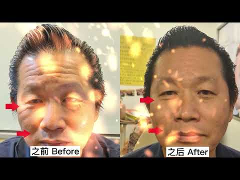 The Forehead Lines and Fine Lines Around The Eyes have also been Significantly Improved!