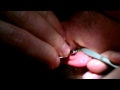 Nasty blackhead removal from girls ear! DISGUSTING ...