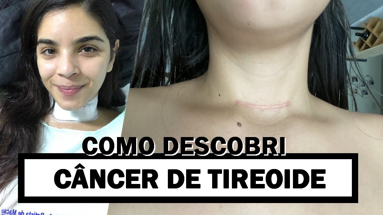 TIVE CÂNCER DE TIREOIDE | CARCINOMA PAPILÍFERO - Nós dois e uma vida