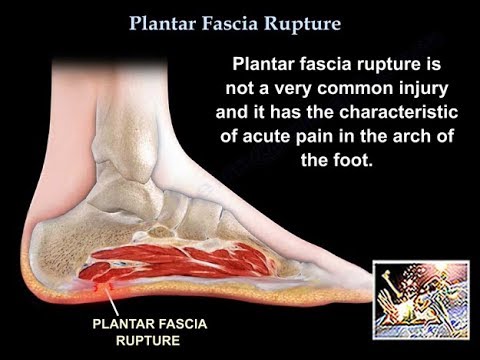 YouTube video about: Which term describes hardened deposits in the plantar fascia?