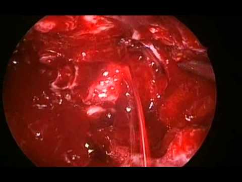 Krwawienie z tętnicy podoczodołowej
