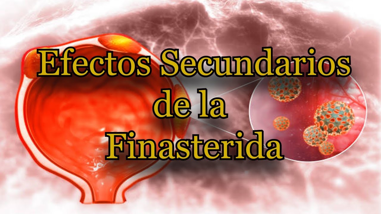 Watch Efectos Secundarios de la Finasterida Now Efectos Secundarios de la Finasterida