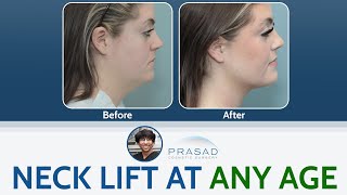 Neck Lift/Neck Tightening at Any Age