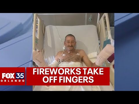 Florida man loses most of his fingers in fireworks explosion