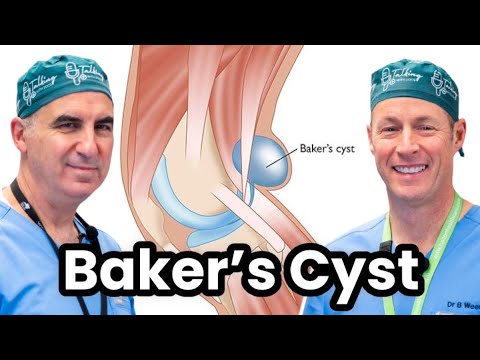 Understanding and Treating Baker's Cyst