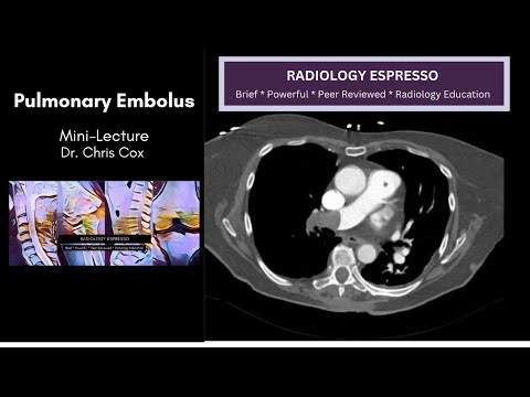 BASICS OF PULMONARY EMBOLISM (on Chest CTA): Mini-lecture, Dr. Chris Cox