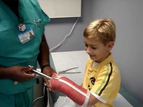Removing An Arm Cast