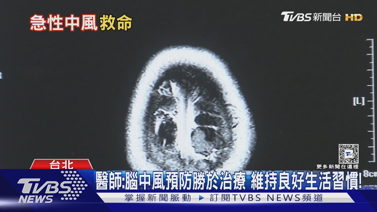 急性中風救命時間拉長!醫師:使用「這方式」救治提高存活率