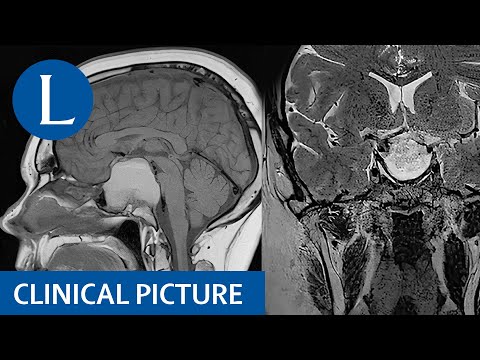 Pituitary apoplexy with a xanthogranuloma