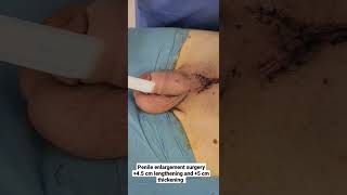 Penile enlargement surgery + 45 cm lengthening and