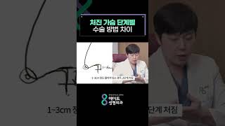 가슴거상으로 처진가슴 올리기❗ 전후사진과 함께 살펴봐요🤩 (Case before and after sagging breast lift surgery)