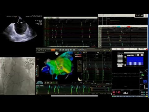 Expert Insights from Dr. Gallinghouse on Afib Ablation