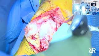 Dr. Stefan Kreuzer performs Right Total Knee Arthroplasty using OMNIBotics.