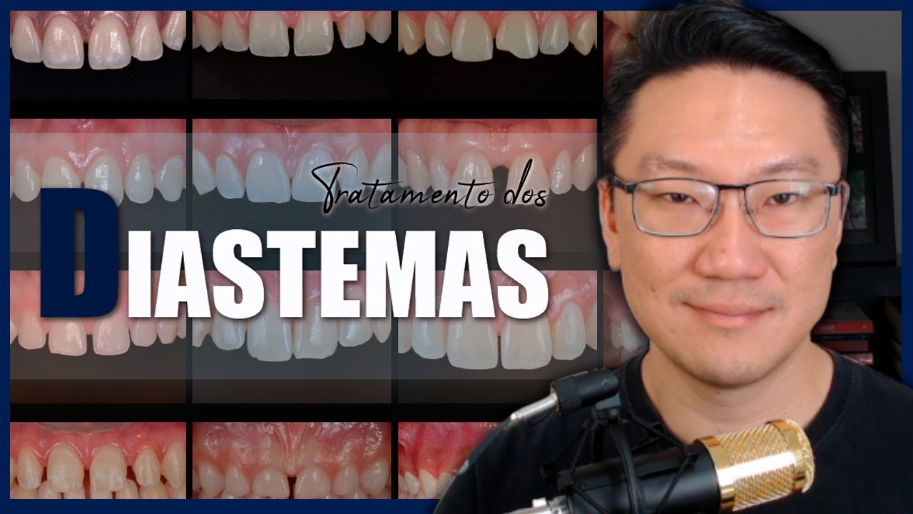Tratamento dos Diastemas